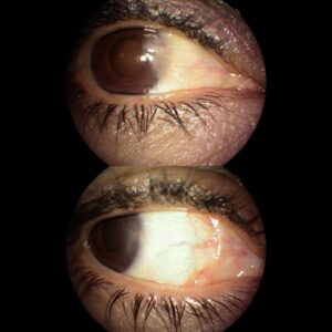ptg before and after