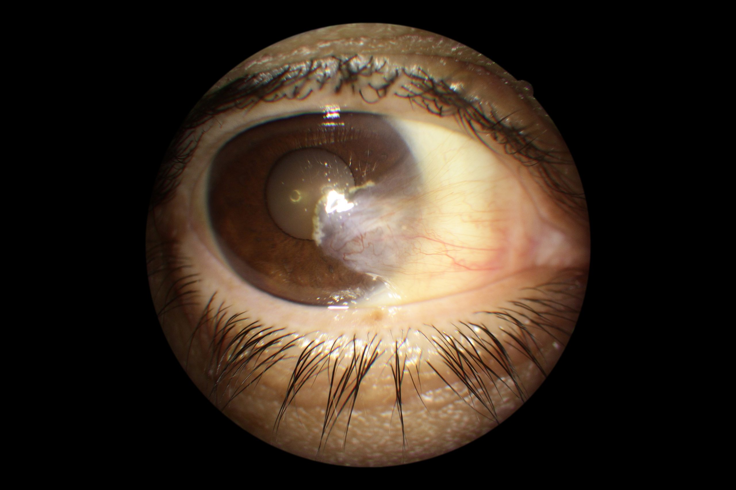 pterygium surgery - carnosidad